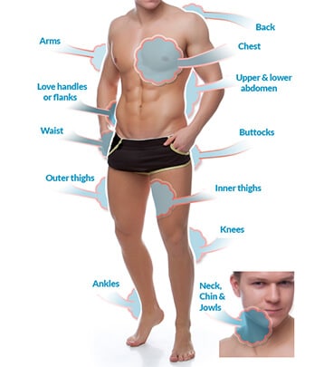 Areas where Liposuction can be performed -Men