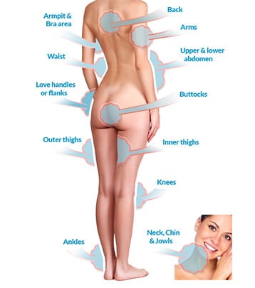 Areas where Liposuction can be performed - Women