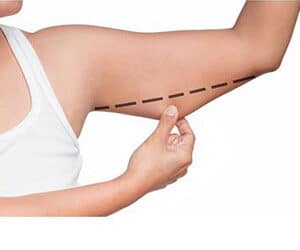Liposuction Arm Lift