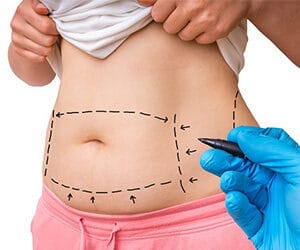 Liposuction abdomen