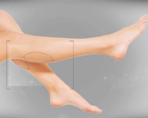 legs and ankel Liposuction