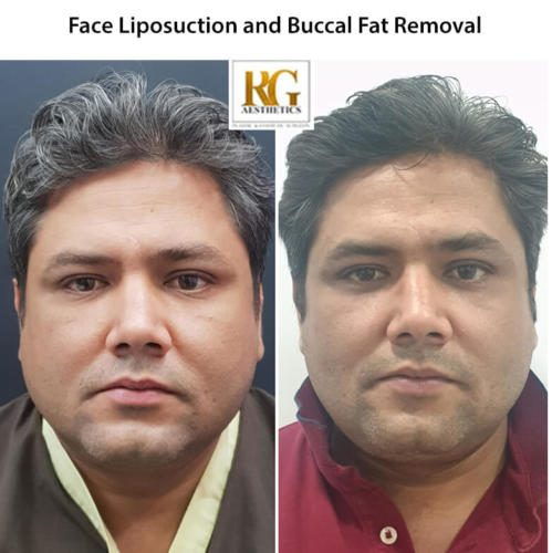 Face-liposuction-and-buccal-fat-removal