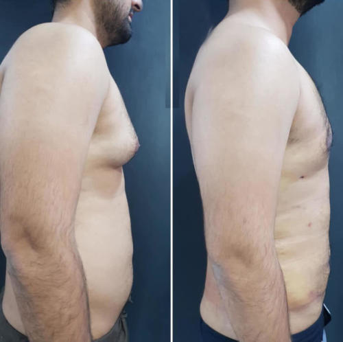 Gynecomastia Surgery