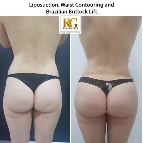 Liposuction-Waist-Contouring-and-Brazilian-Buttock-Lift
