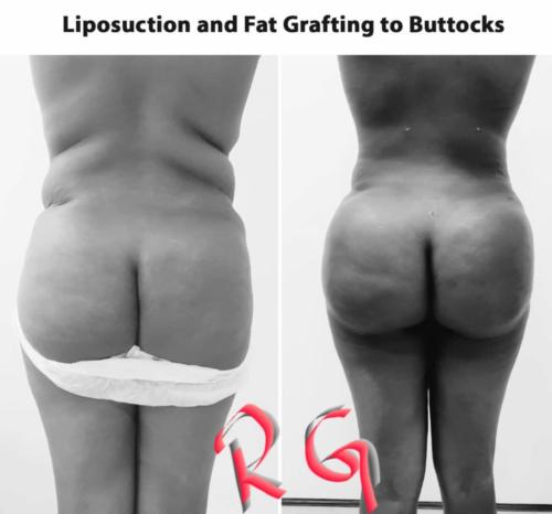 Liposuction-and-Fat-grafting-to-buttocks